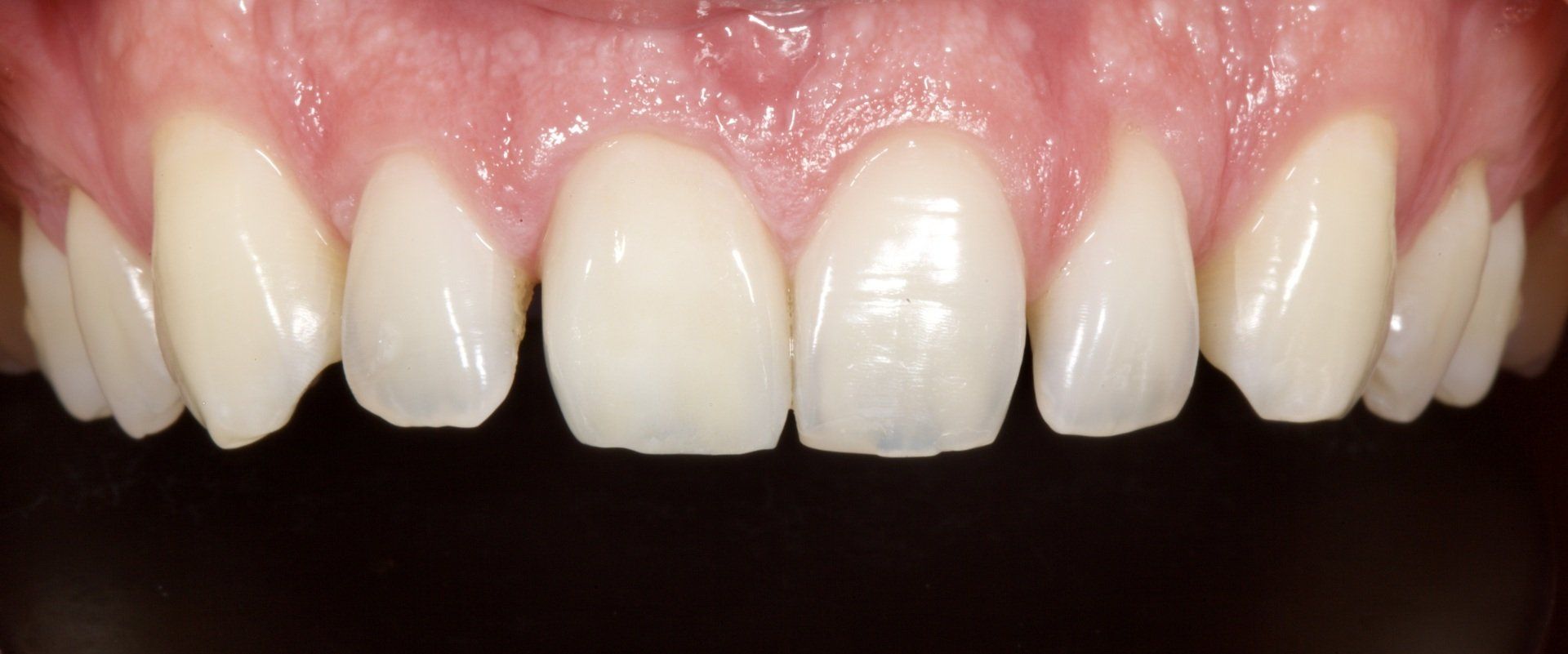 After Crowning Teeth — Menai, NSW — Top Care Dental