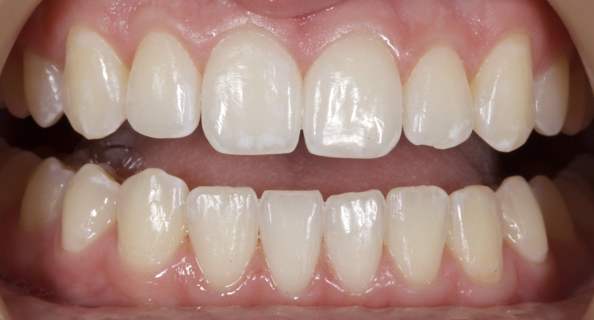 After Teeth Whitening — Menai, NSW — Top Care Dental