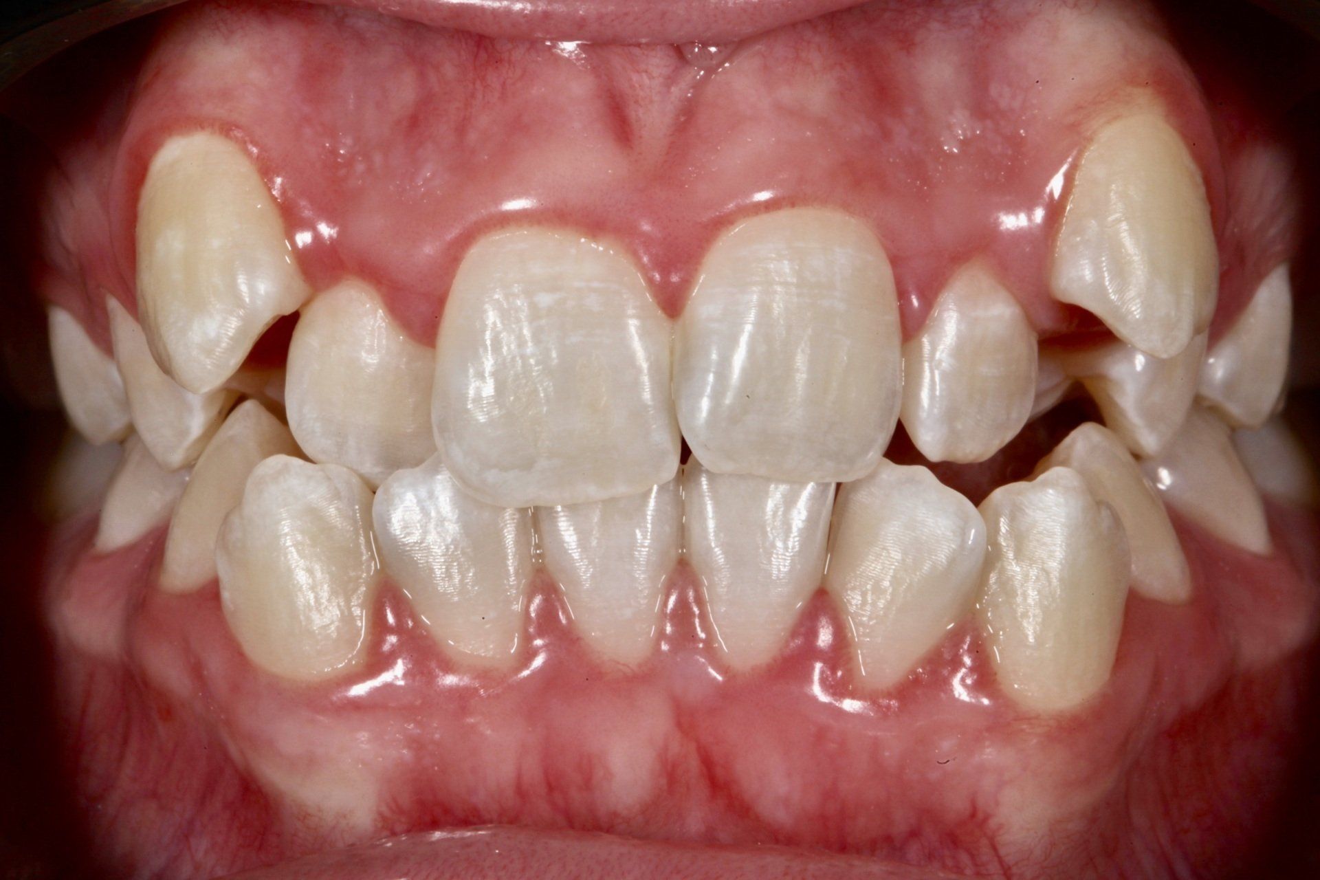 Crooked Teeth Before — Menai, NSW — Top Care Dental
