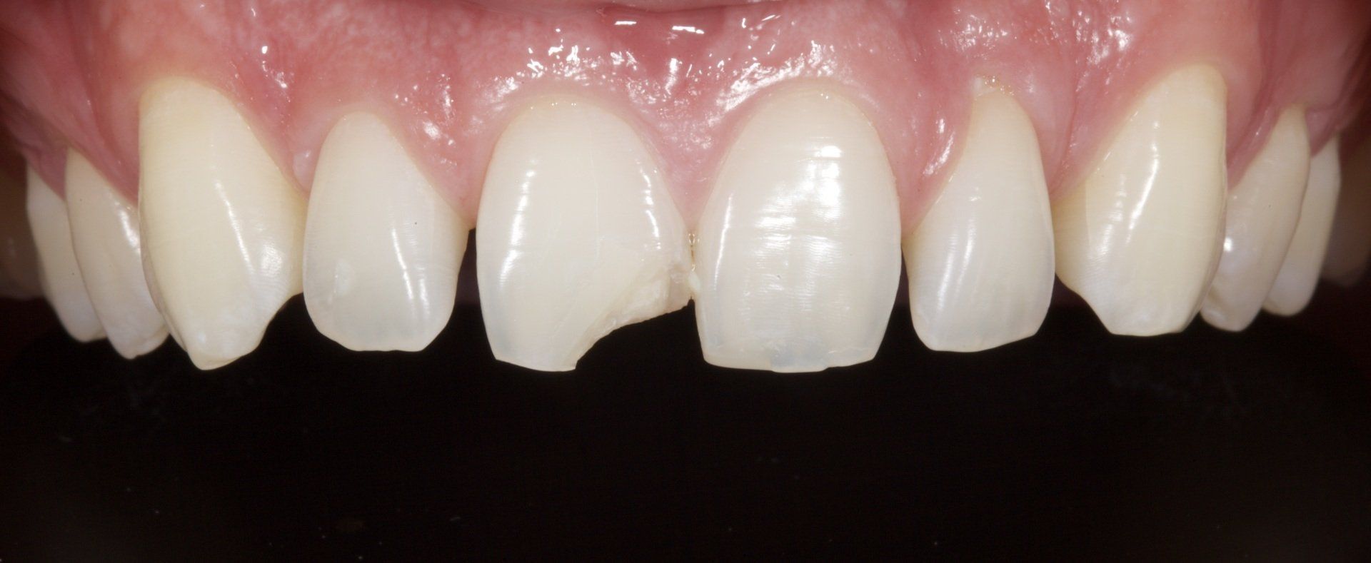 Before Broken Teeth — Menai, NSW — Top Care Dental
