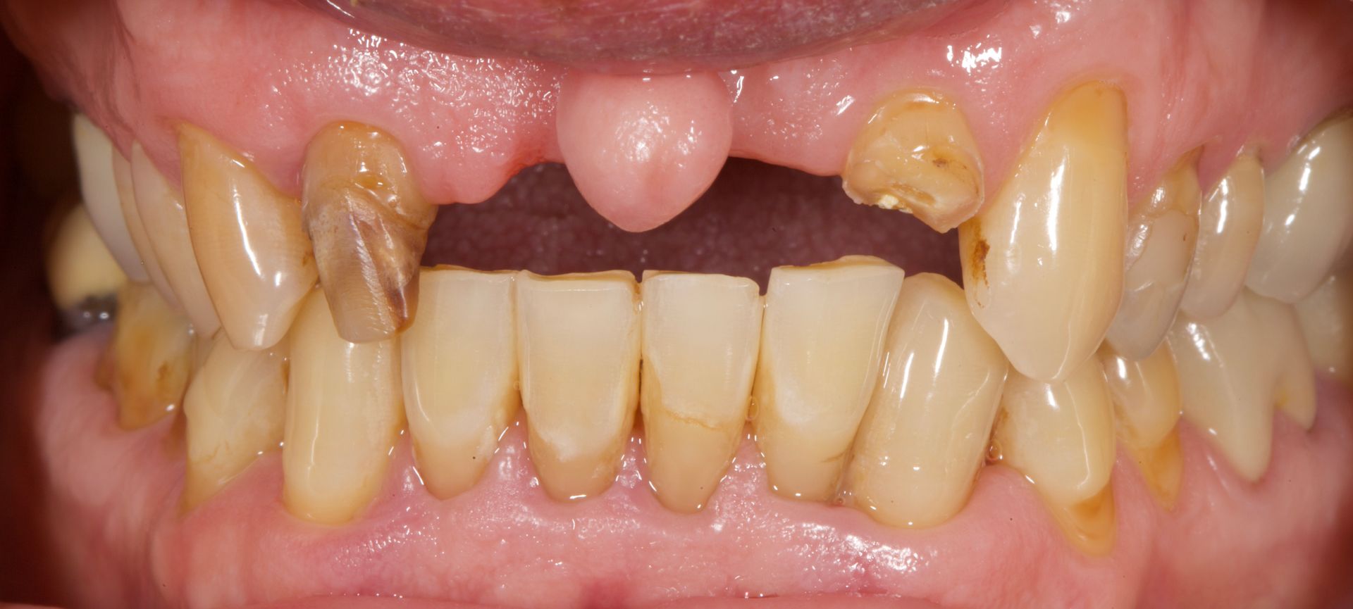 Before Teeth Close-Up — Menai, NSW — Top Care Dental