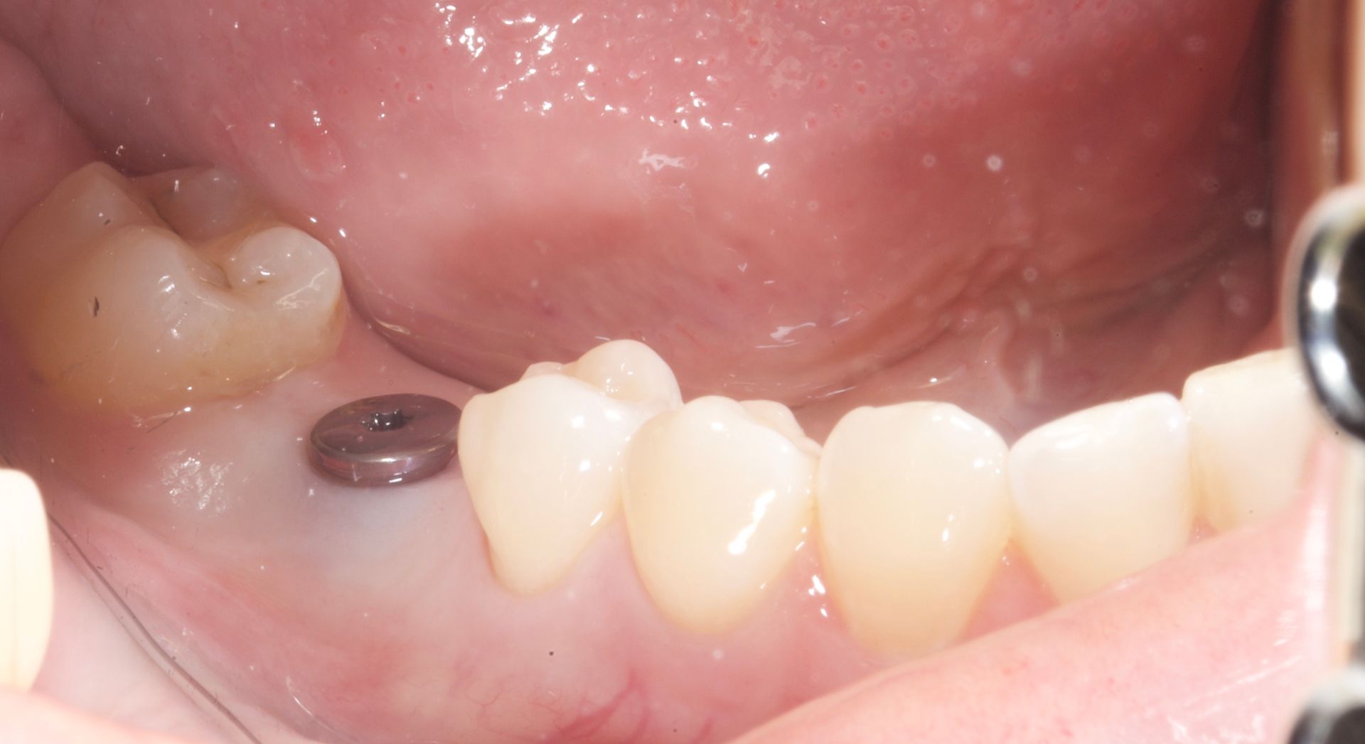 Before Bicuspids Implant — Menai, NSW — Top Care Dental