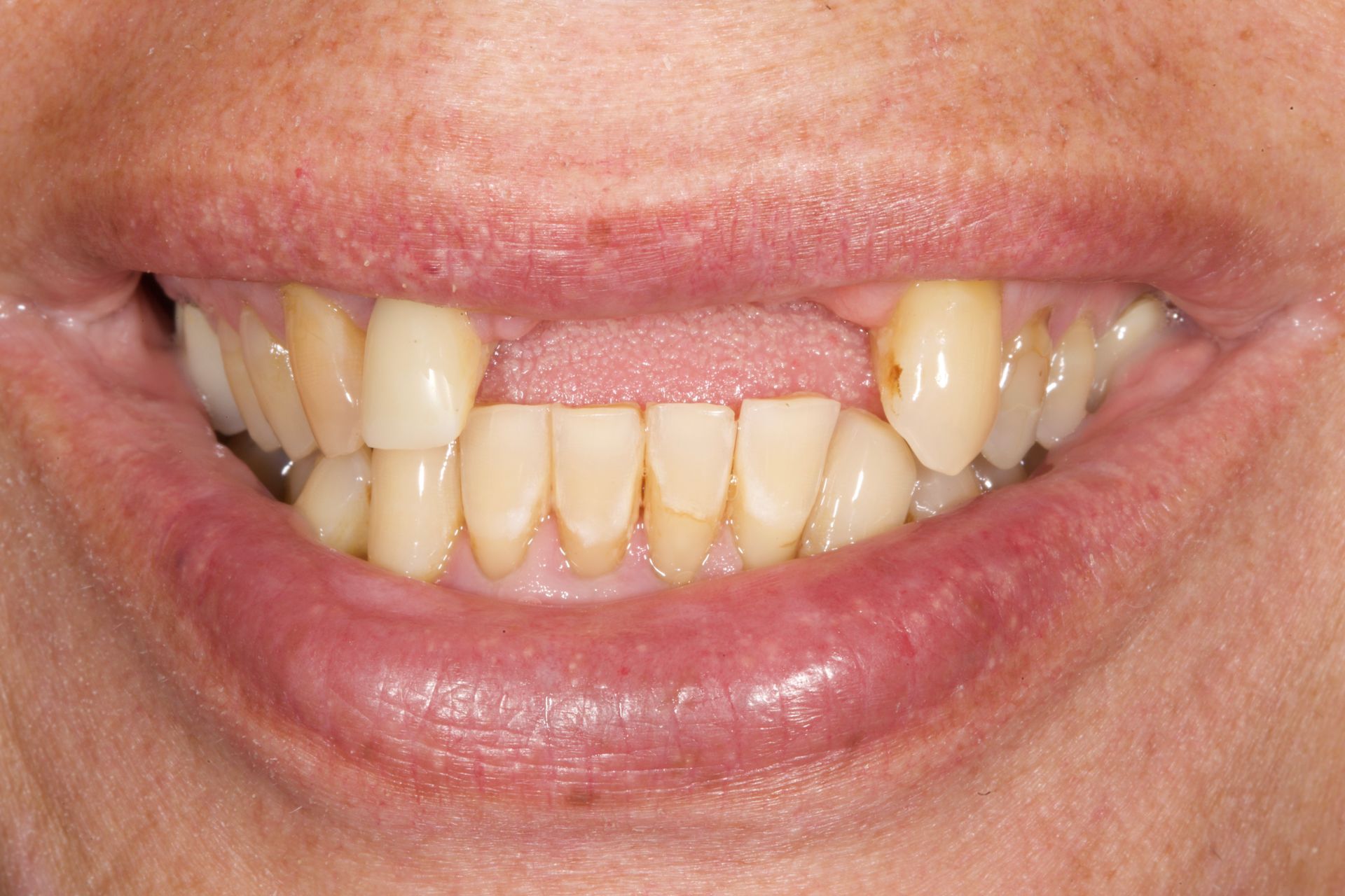 Before Teeth Close-Up — Menai, NSW — Top Care Dental