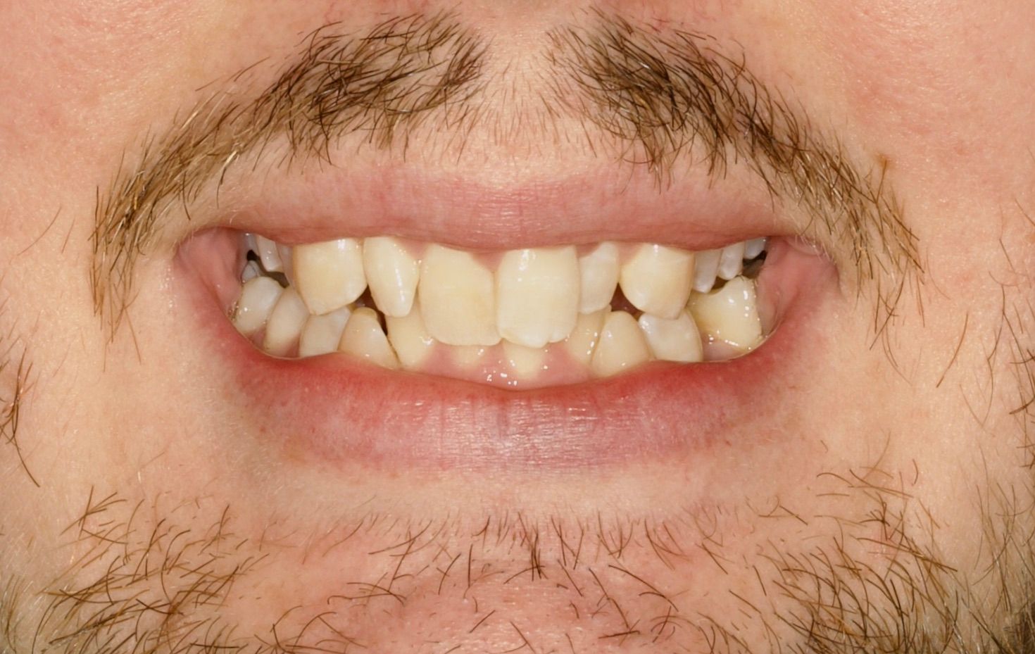 Before Teeth Close-Up — Menai, NSW — Top Care Dental