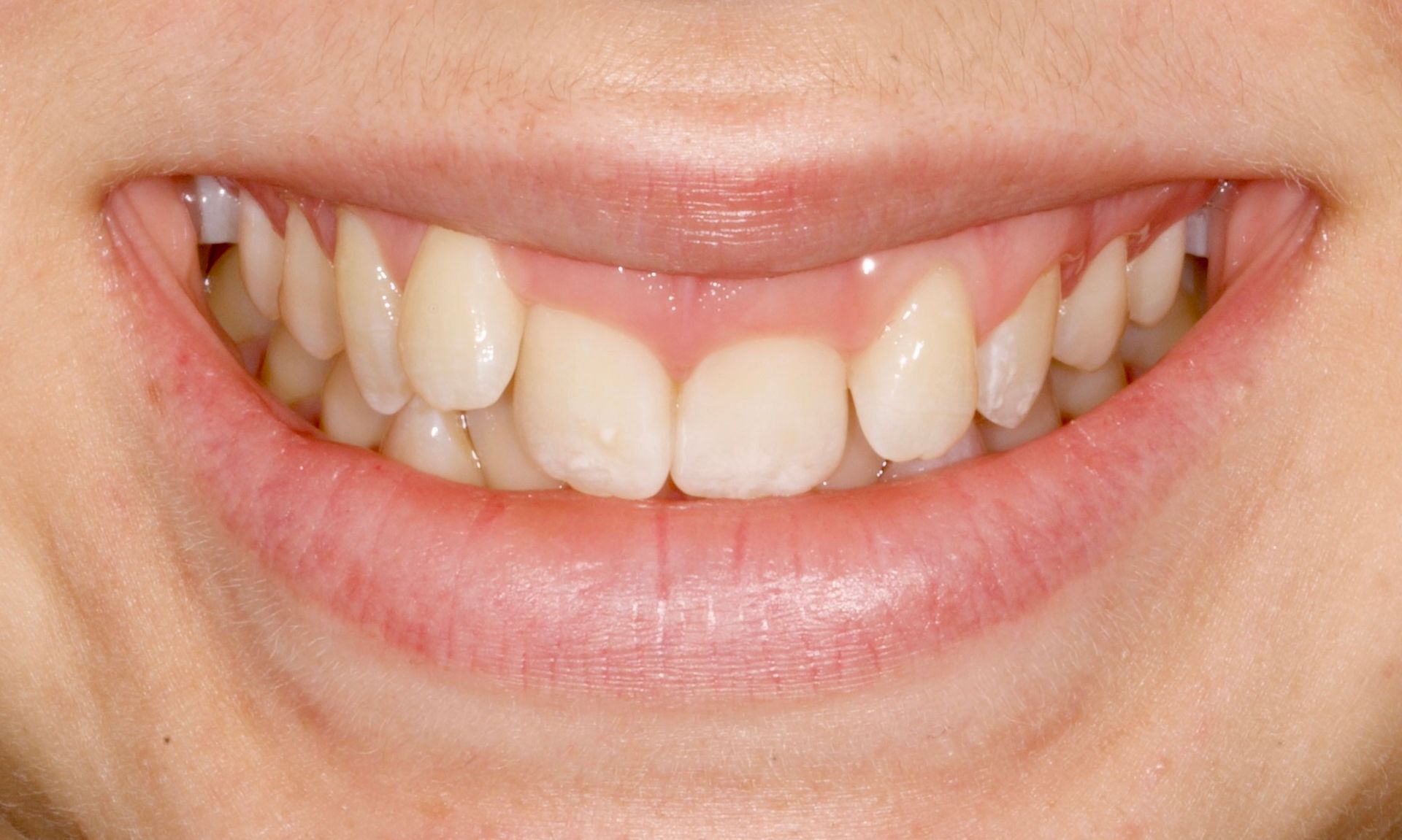 Before Teeth Close-Up — Menai, NSW — Top Care Dental