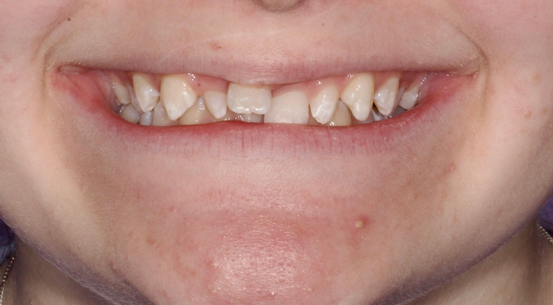 Crooked Teeth Before — Menai, NSW — Top Care Dental