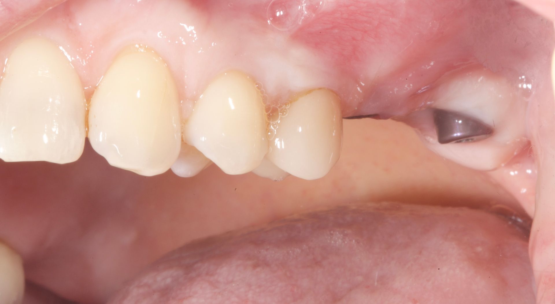 Before Top Molars Implant — Menai, NSW — Top Care Dental