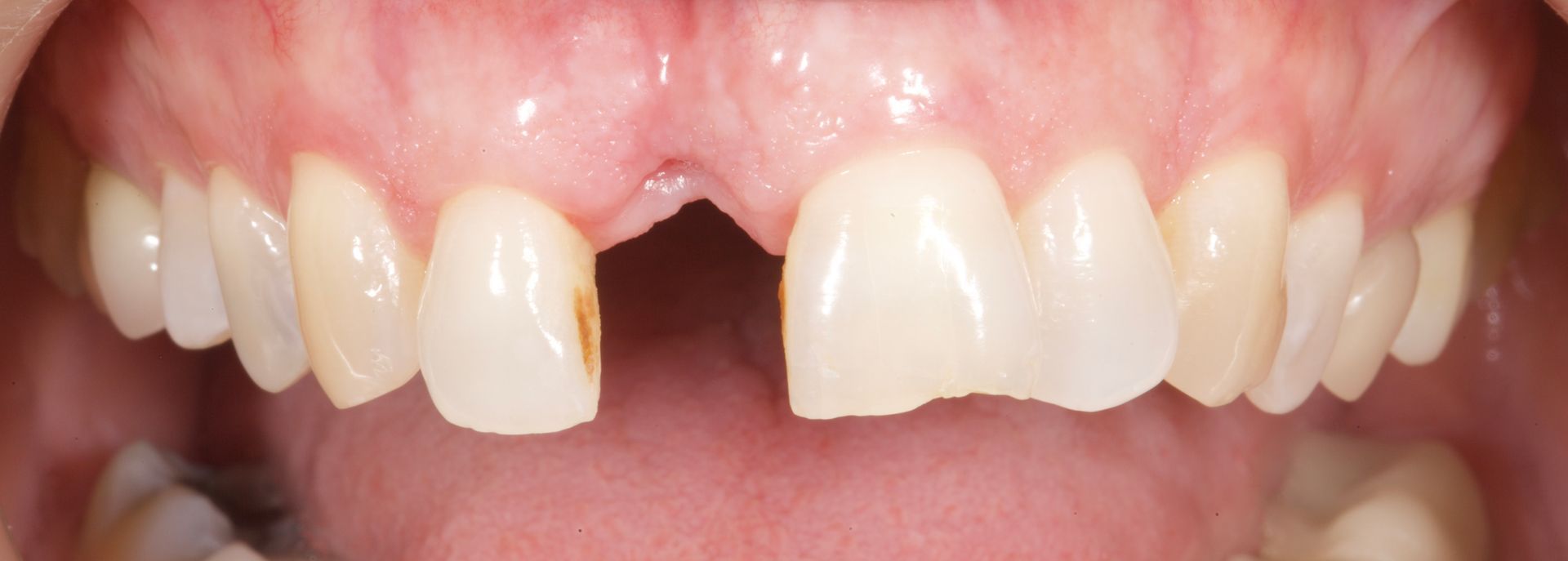 Before Bottom Teeth — Menai, NSW — Top Care Dental