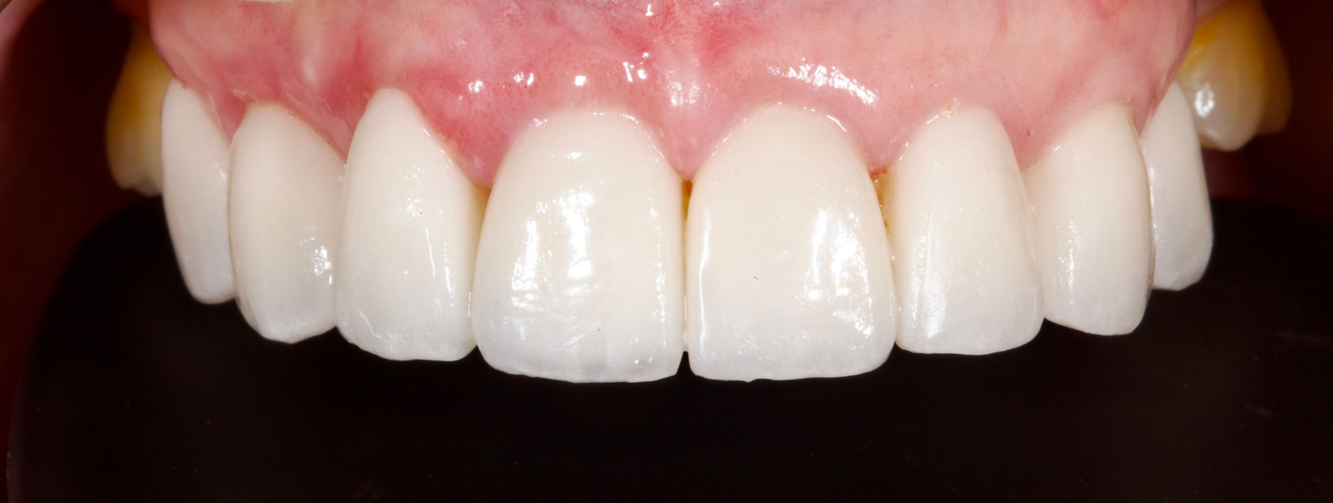 After Teeth Close-Up — Menai, NSW — Top Care Dental