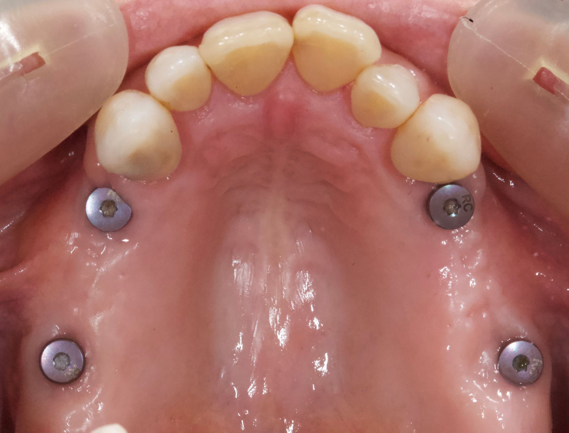 Front Teeth Before the Implant — Menai, NSW — Top Care Dental