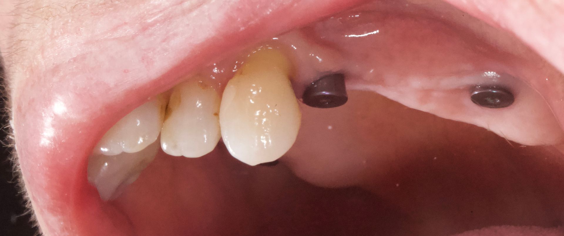 Before the Implant — Menai, NSW — Top Care Dental