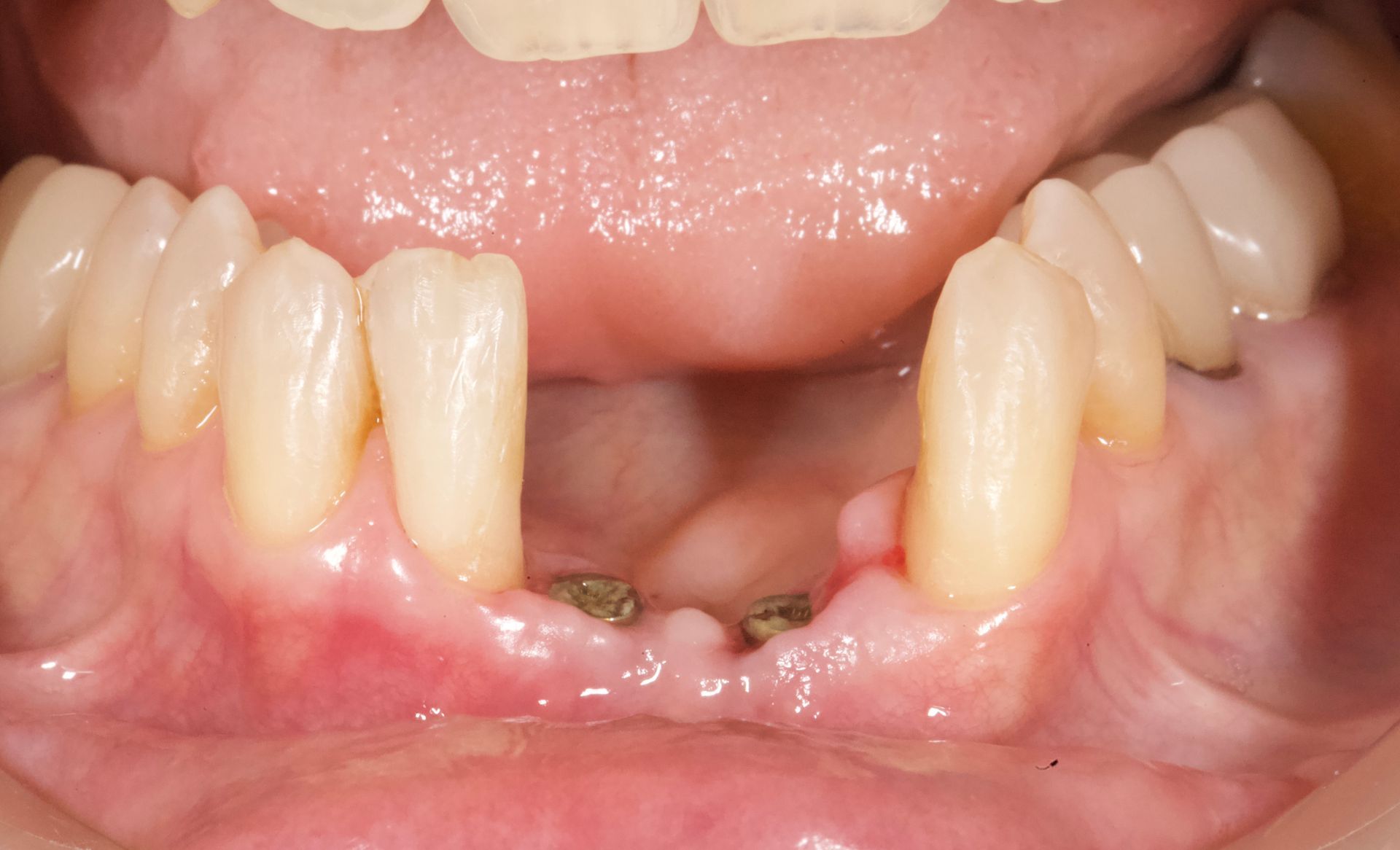 Before Molars Implant — Menai, NSW — Top Care Dental