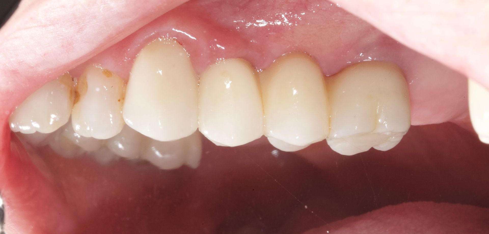 After the Implant — Menai, NSW — Top Care Dental