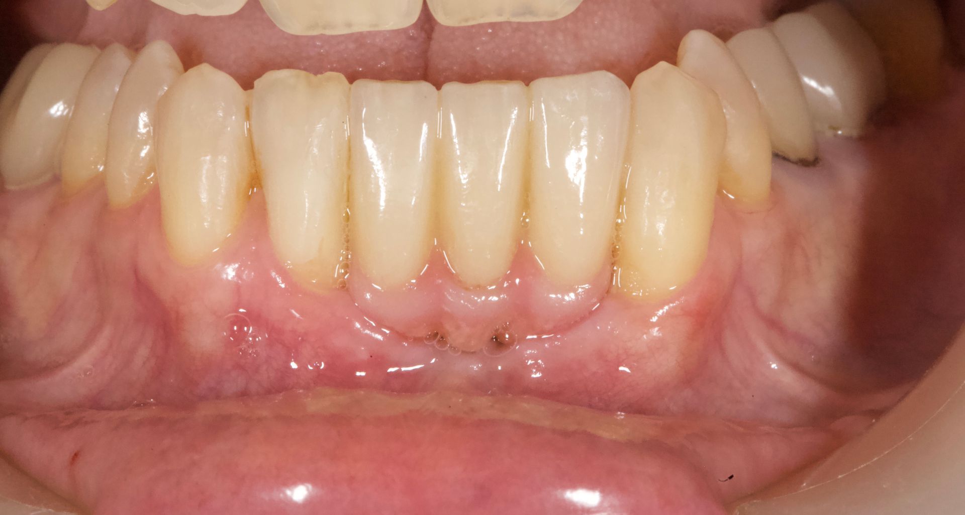 After Molars Implant — Menai, NSW — Top Care Dental
