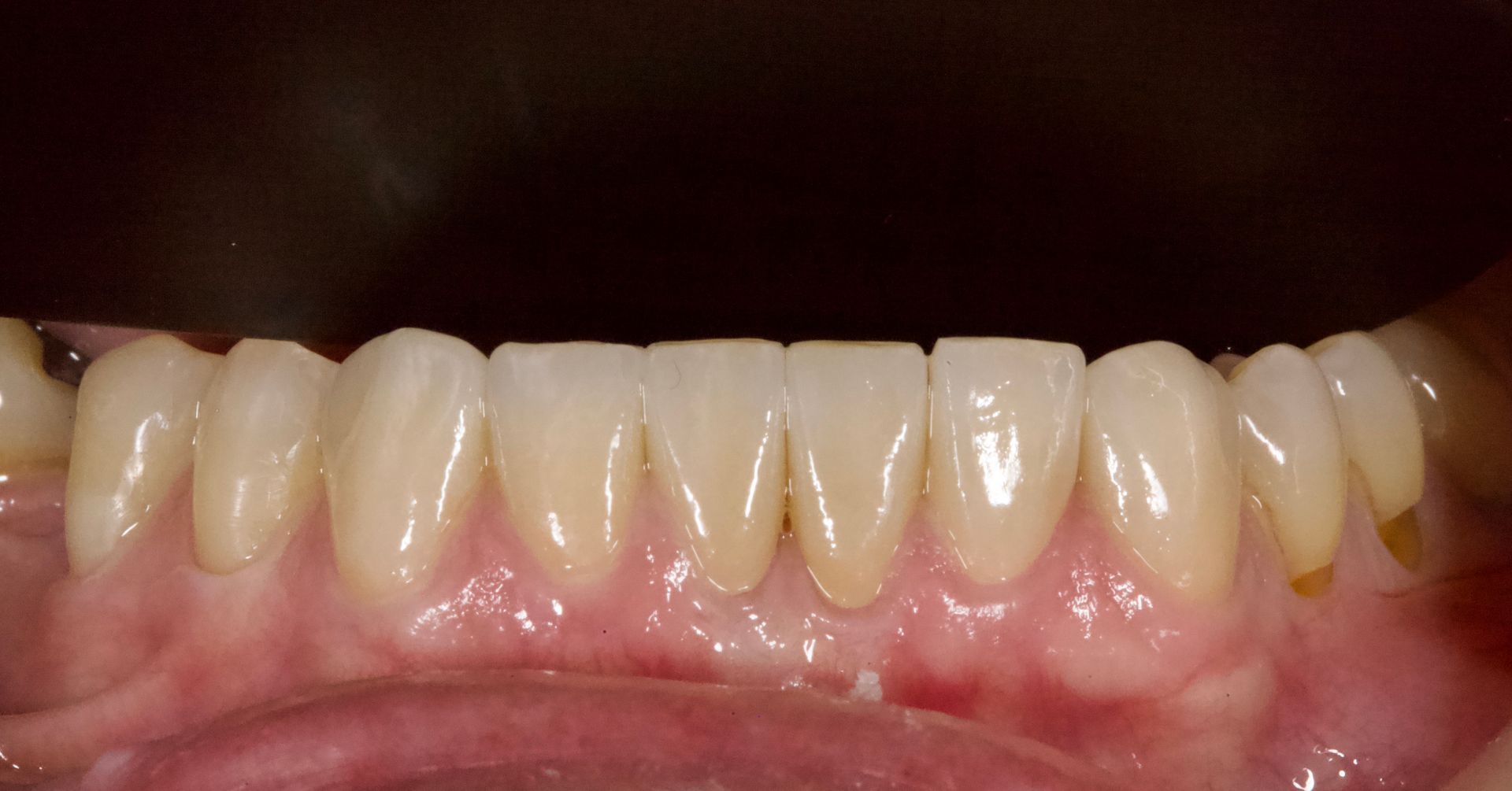 After Bottom Teeth — Menai, NSW — Top Care Dental