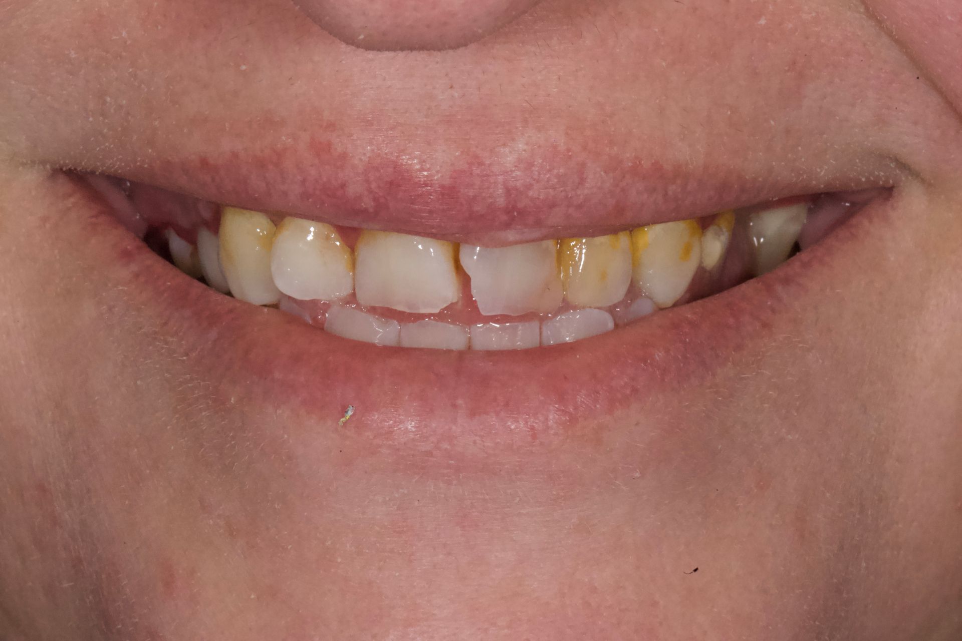 Before Bottom Teeth — Menai, NSW — Top Care Dental
