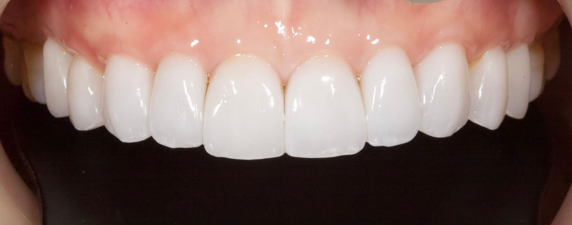After Bottom Teeth — Menai, NSW — Top Care Dental