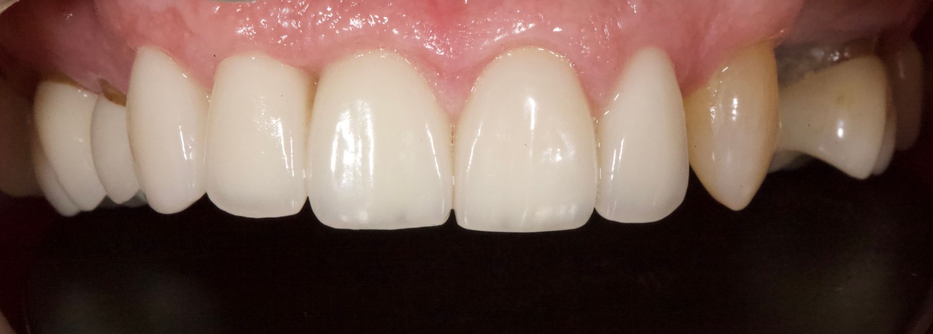 After Teeth Close-Up — Menai, NSW — Top Care Dental