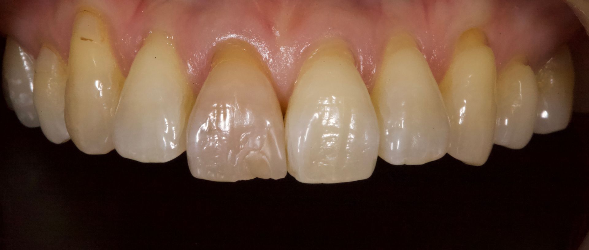 Before Bottom Teeth — Menai, NSW — Top Care Dental