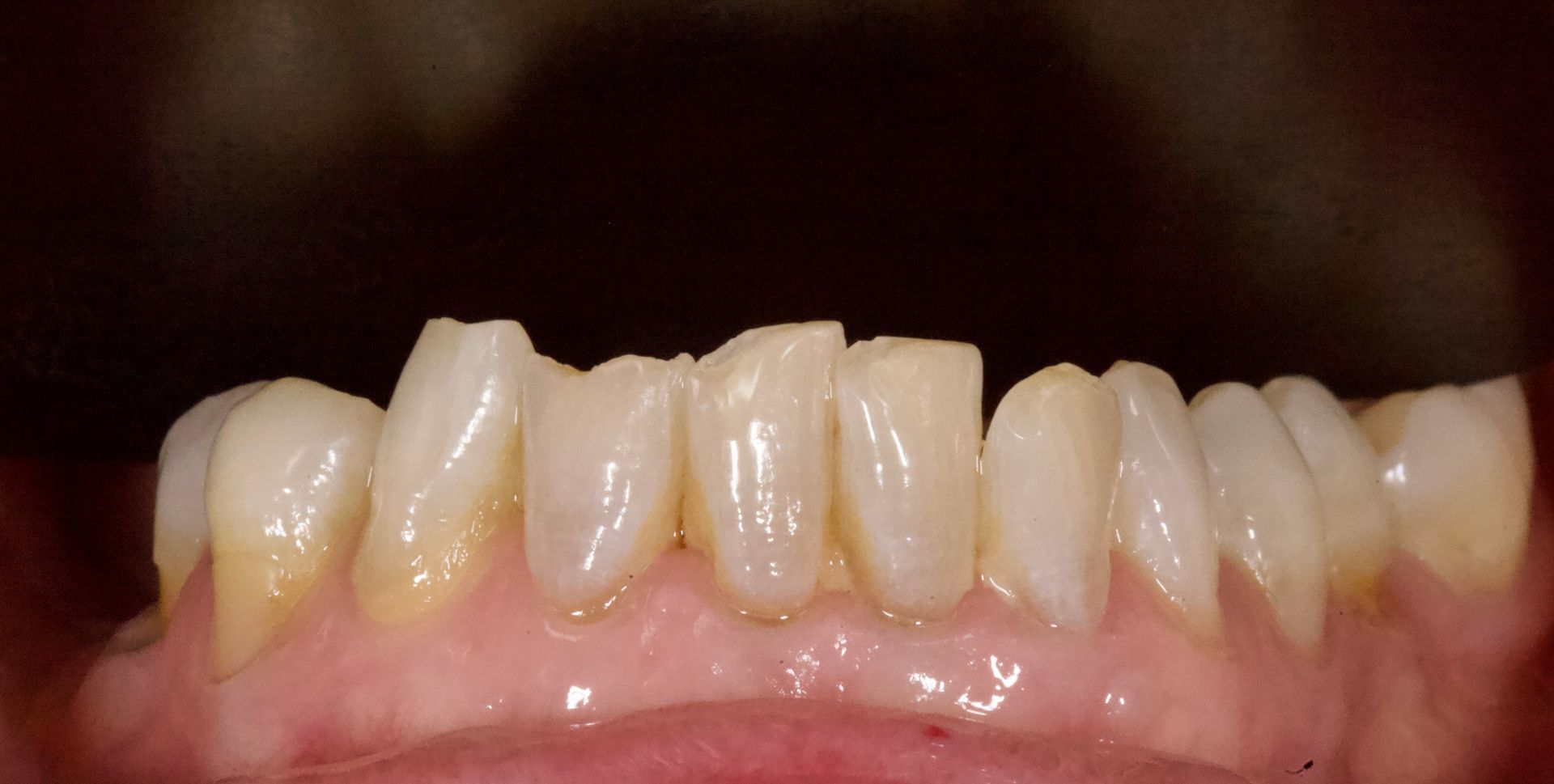 Before Bottom Teeth — Menai, NSW — Top Care Dental