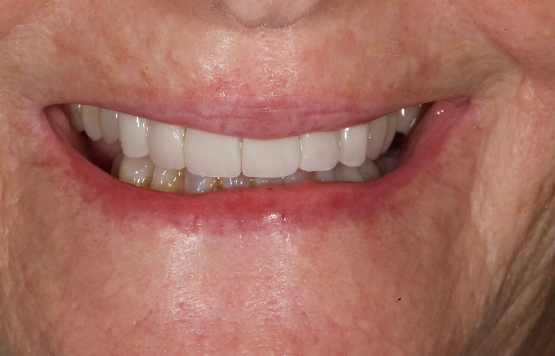 After Bottom Teeth — Menai, NSW — Top Care Dental