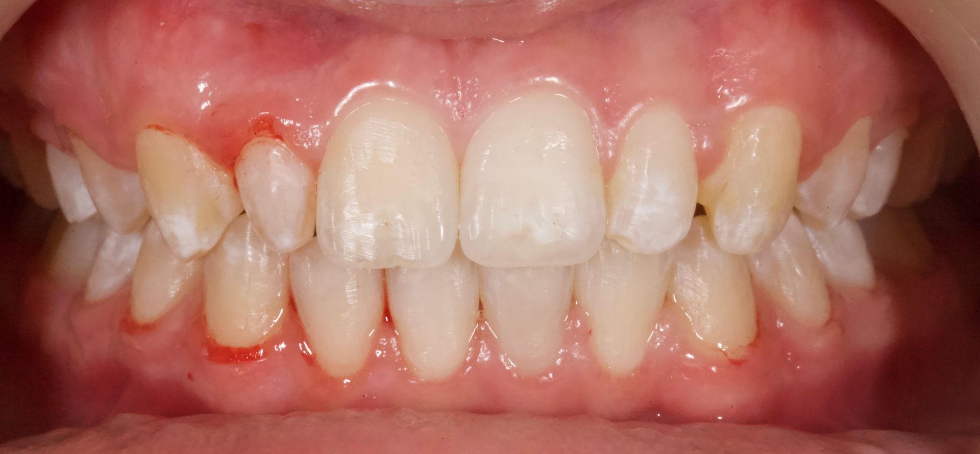 After Teeth Close-Up — Menai, NSW — Top Care Dental