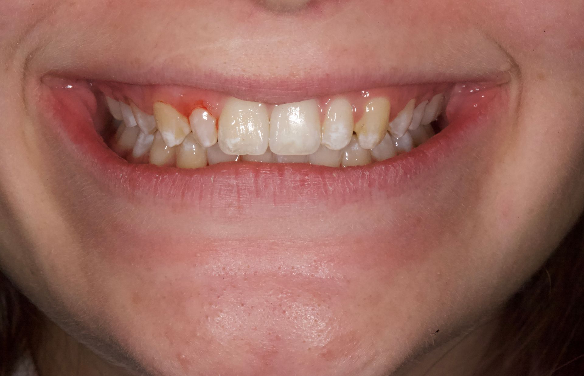 Crooked Teeth After — Menai, NSW — Top Care Dental