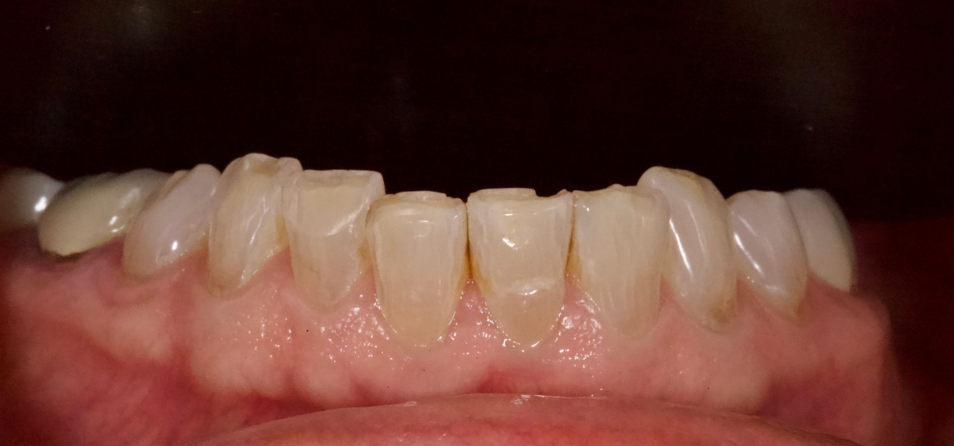 Before Bottom Teeth — Menai, NSW — Top Care Dental