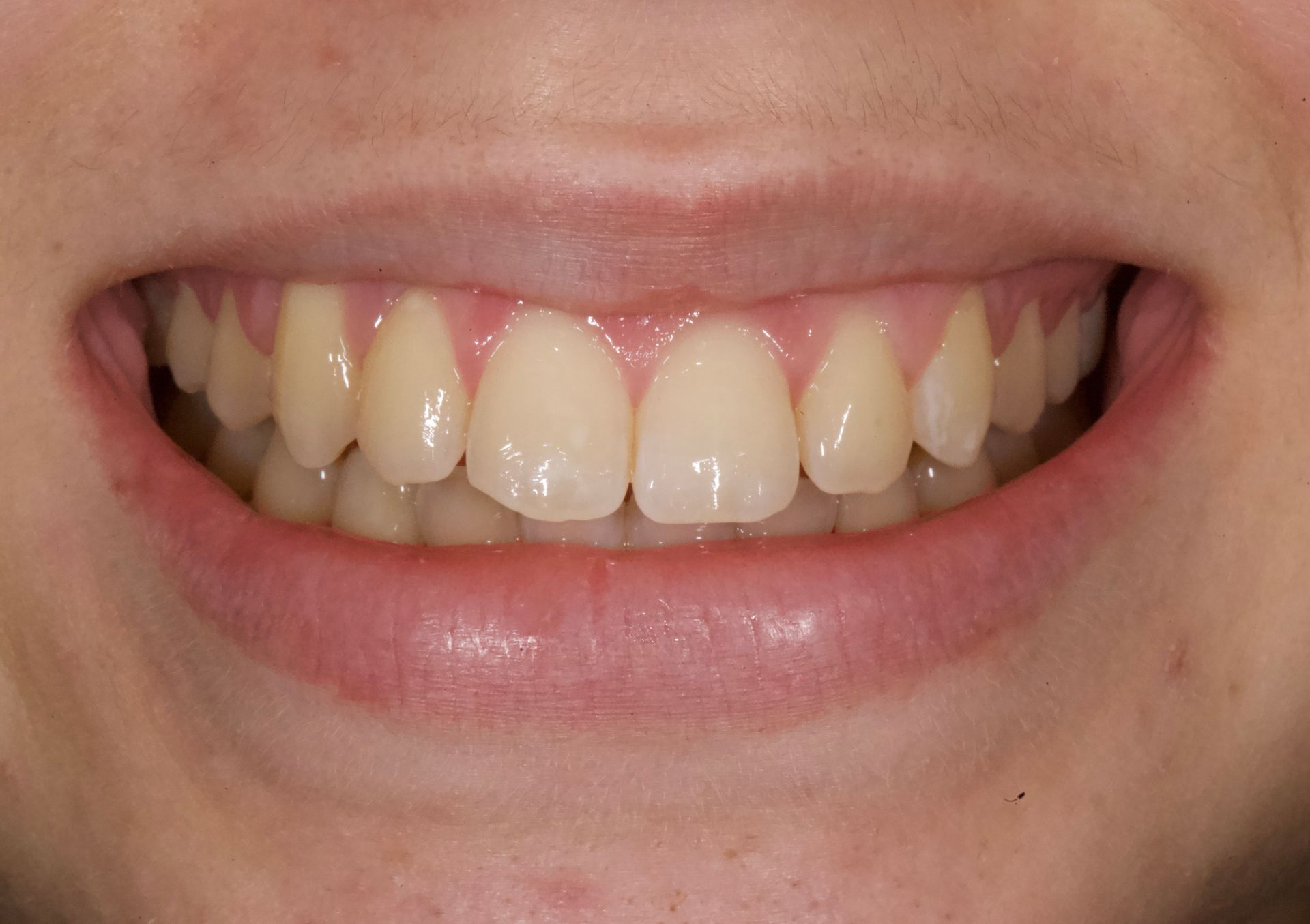 After Teeth Close-Up — Menai, NSW — Top Care Dental