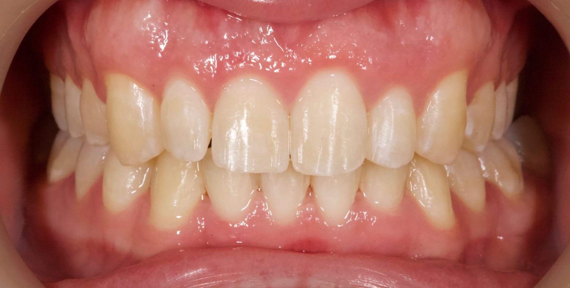 Crooked Teeth After — Menai, NSW — Top Care Dental