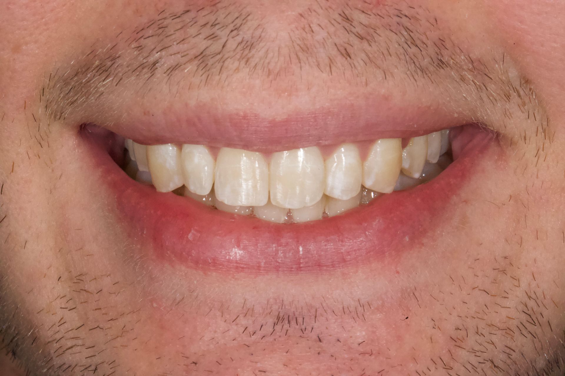 After Teeth Close-Up — Menai, NSW — Top Care Dental