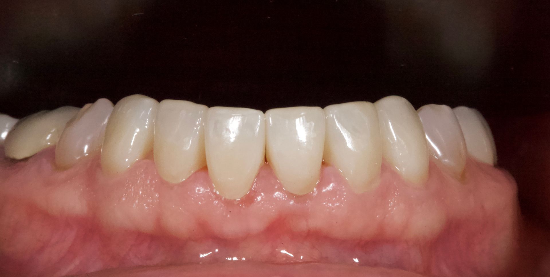 After Bottom Teeth — Menai, NSW — Top Care Dental