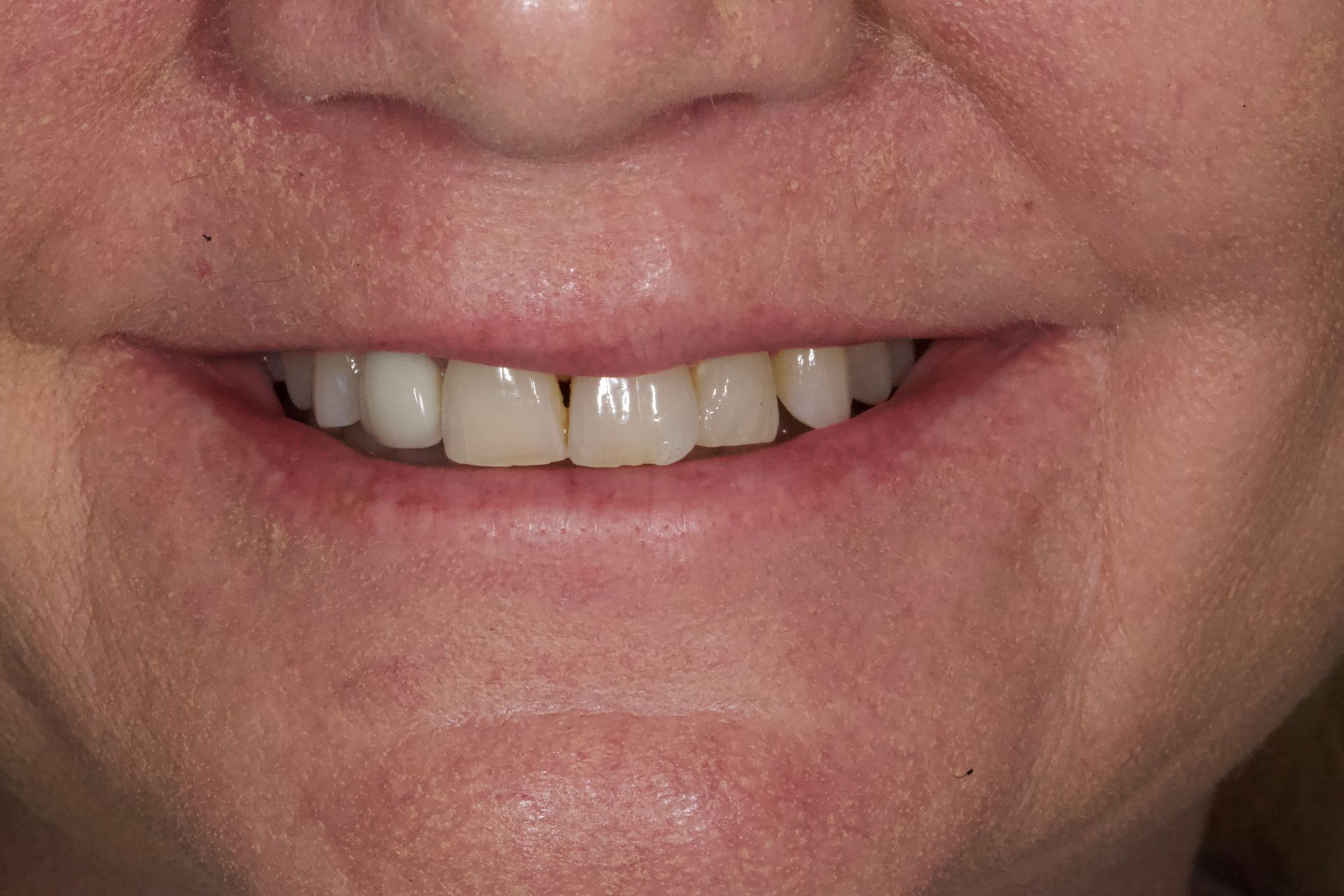 Before Bottom Teeth — Menai, NSW — Top Care Dental