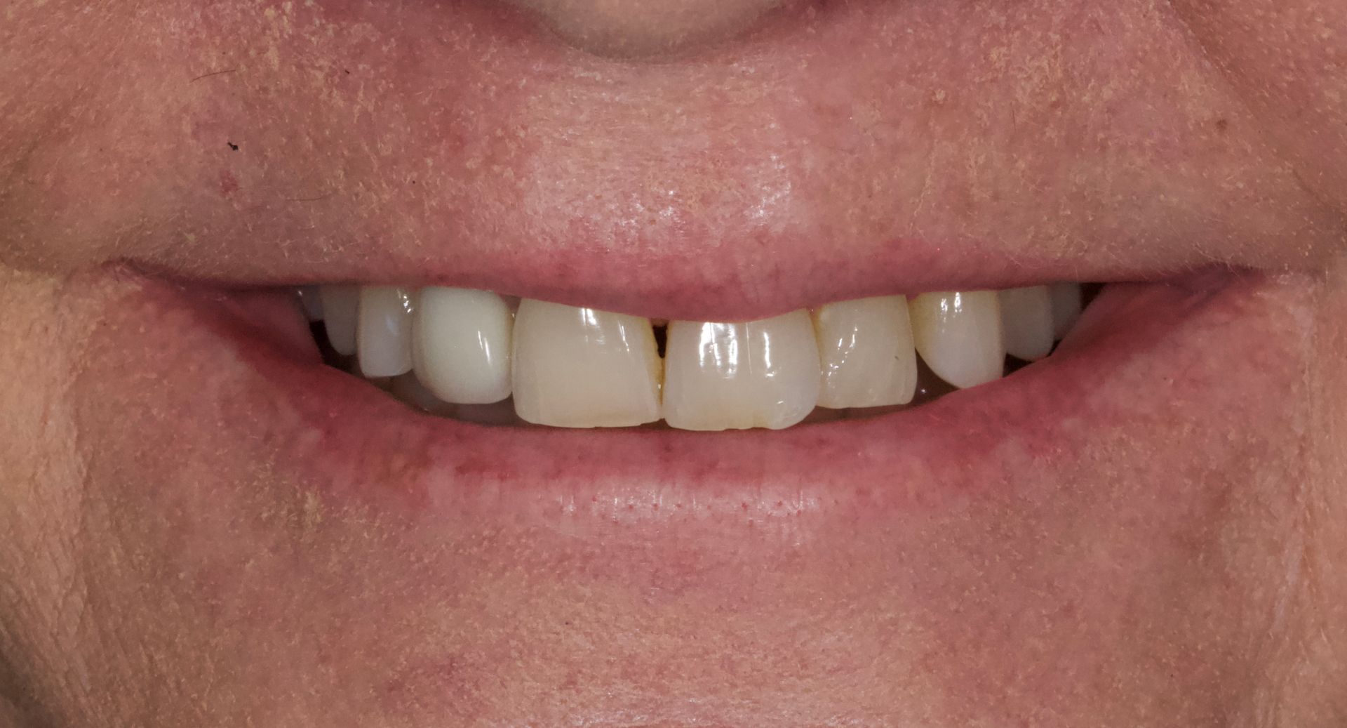 Before Bottom Teeth — Menai, NSW — Top Care Dental