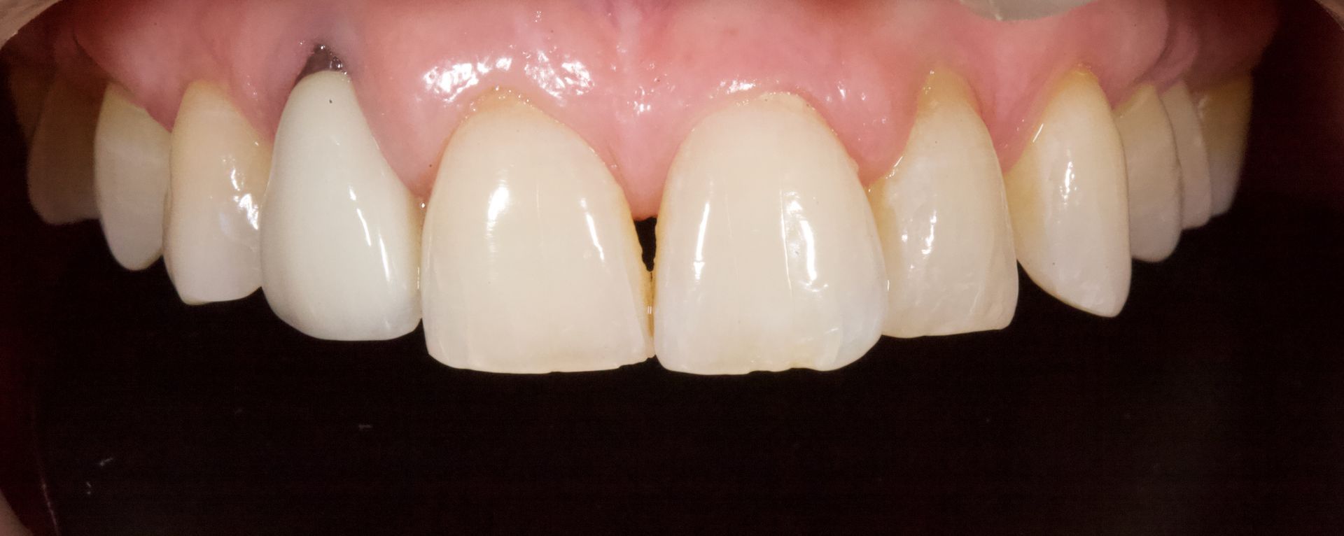 Before Bottom Teeth — Menai, NSW — Top Care Dental