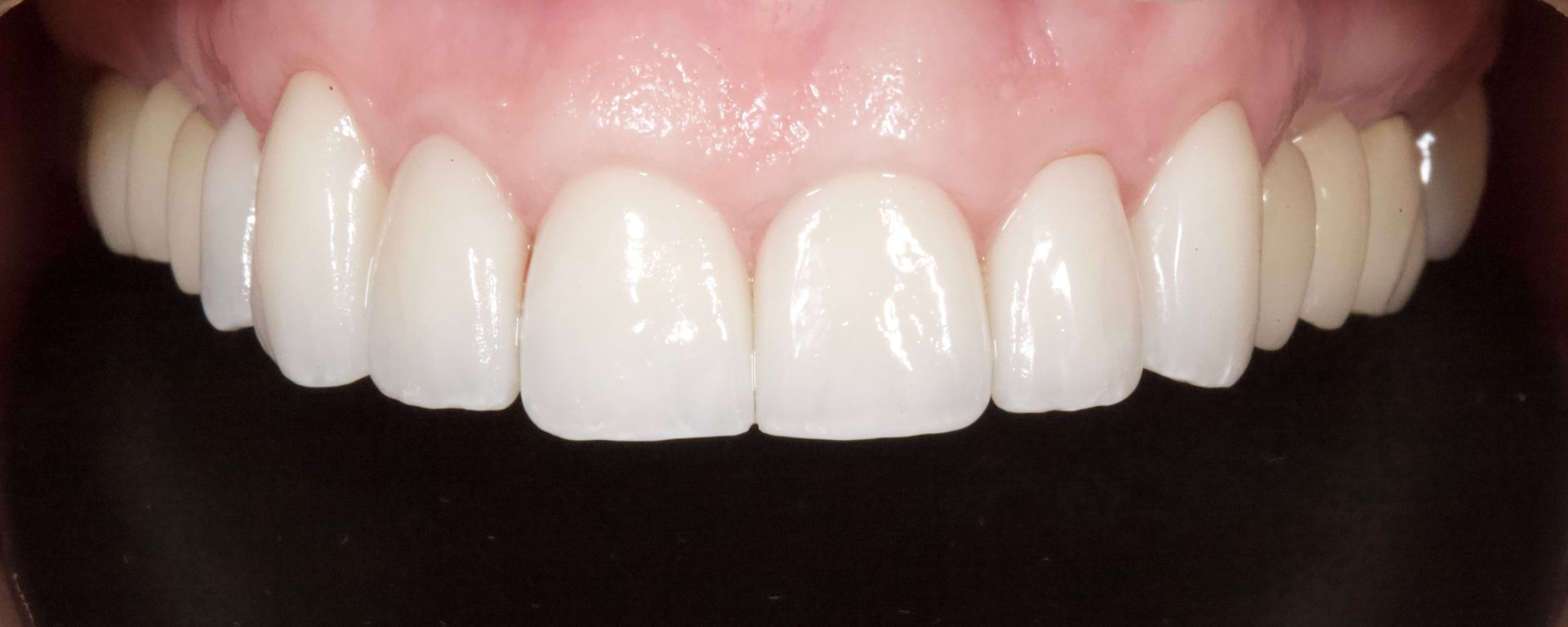 After Bottom Teeth — Menai, NSW — Top Care Dental