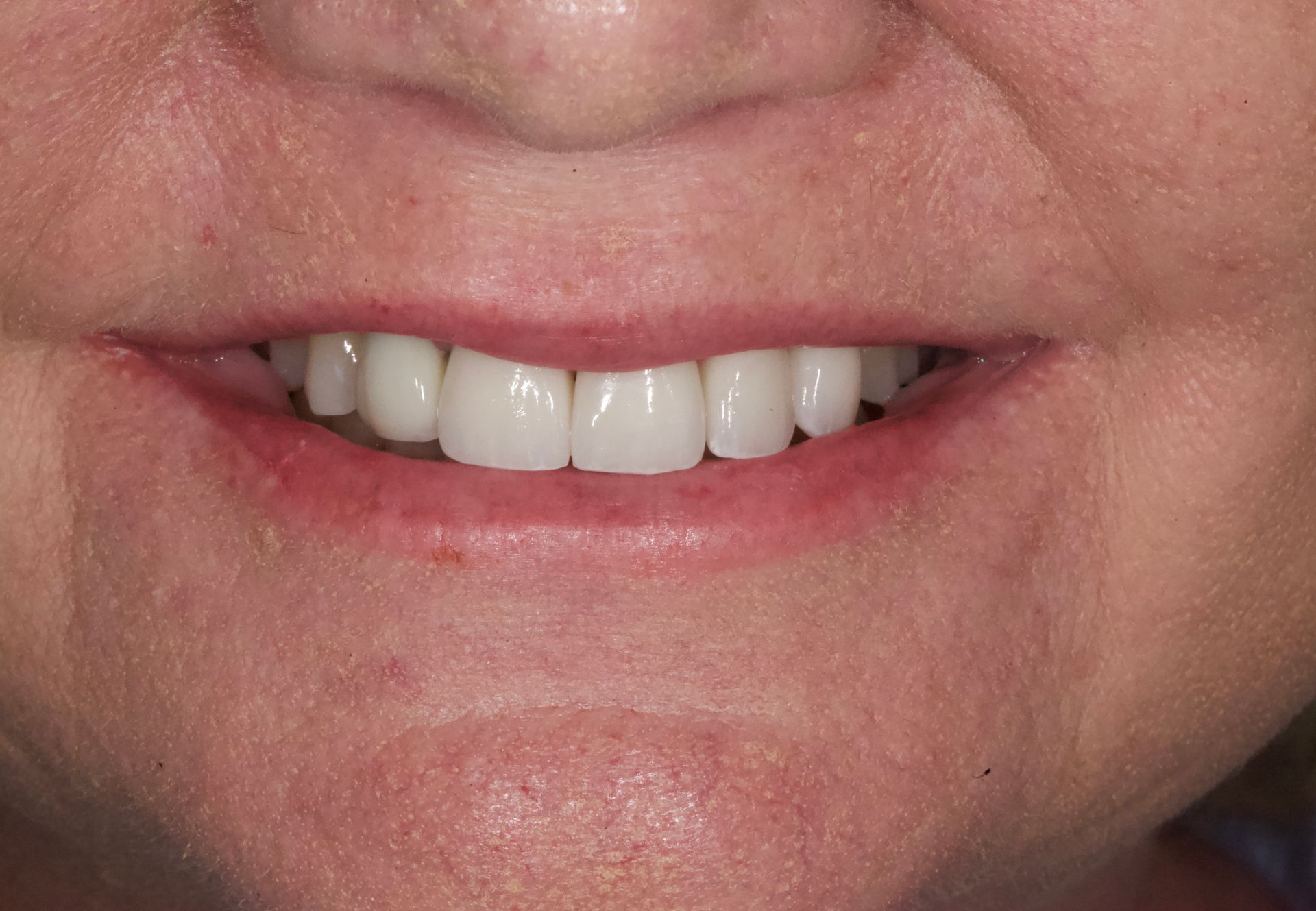 After Bottom Teeth — Menai, NSW — Top Care Dental