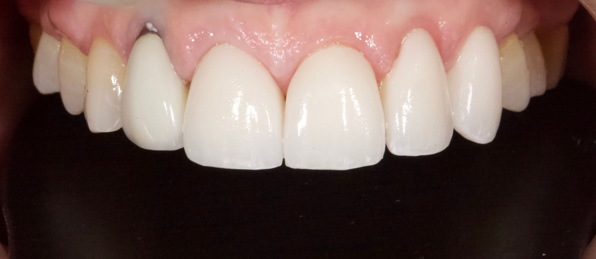 After Bottom Teeth — Menai, NSW — Top Care Dental