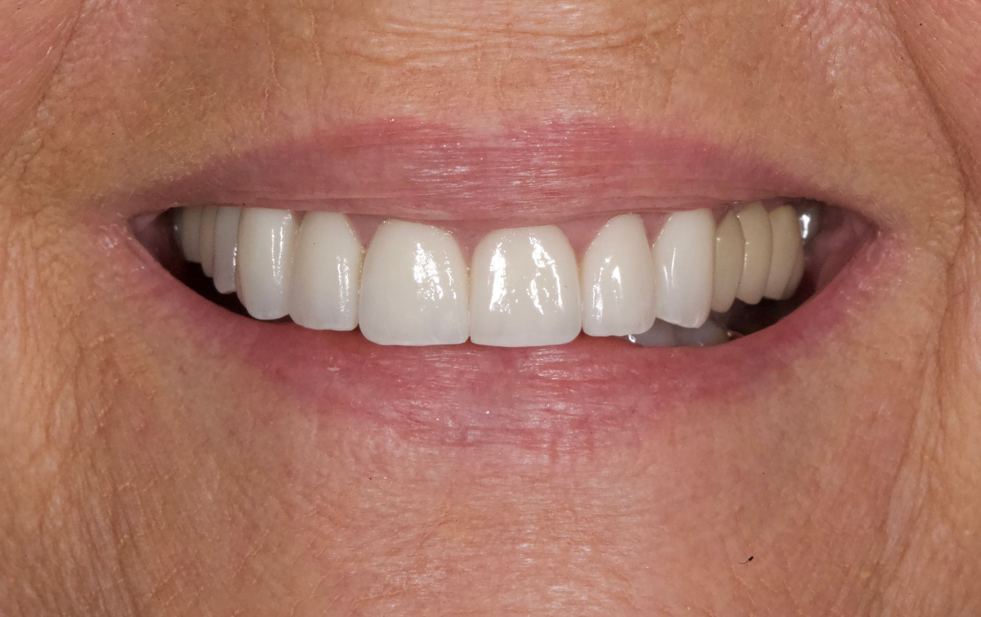 After Bottom Teeth — Menai, NSW — Top Care Dental