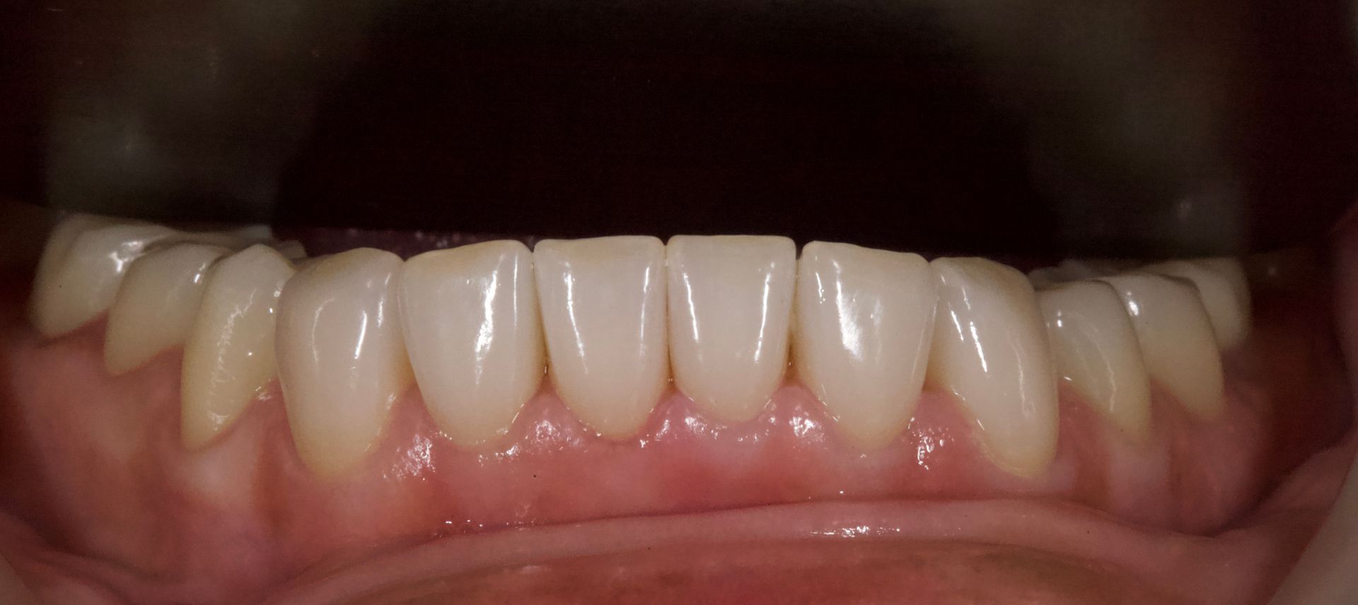 After Bottom Teeth — Menai, NSW — Top Care Dental