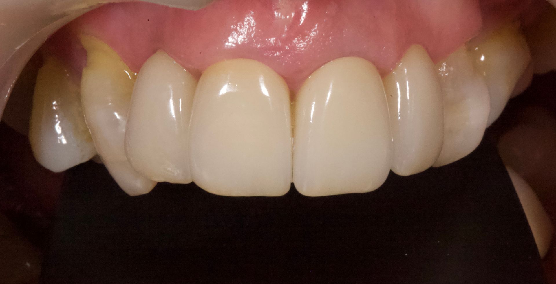 After Bottom Teeth — Menai, NSW — Top Care Dental