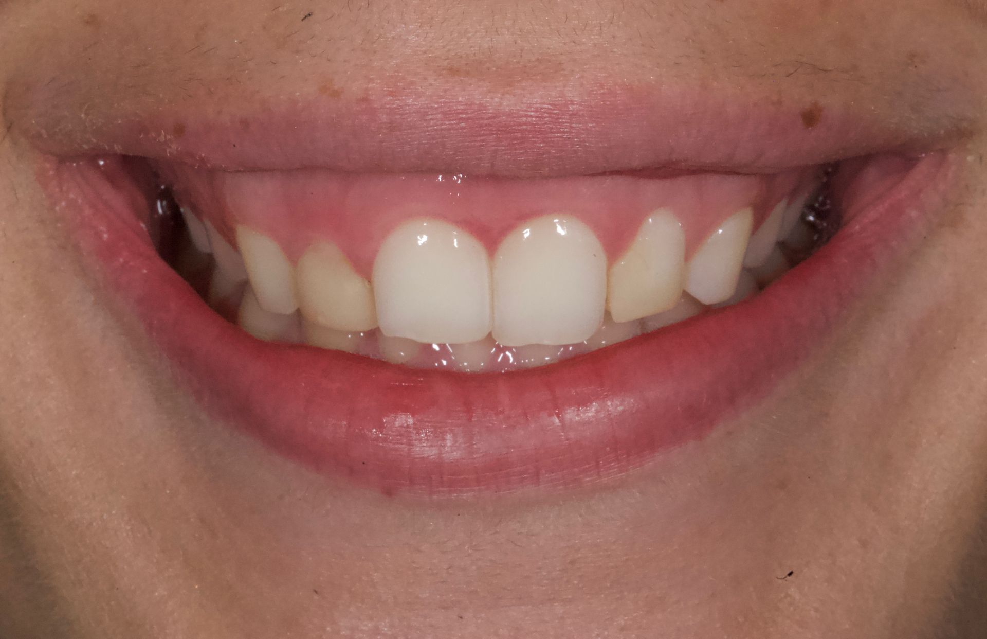 Before Bottom Teeth — Menai, NSW — Top Care Dental