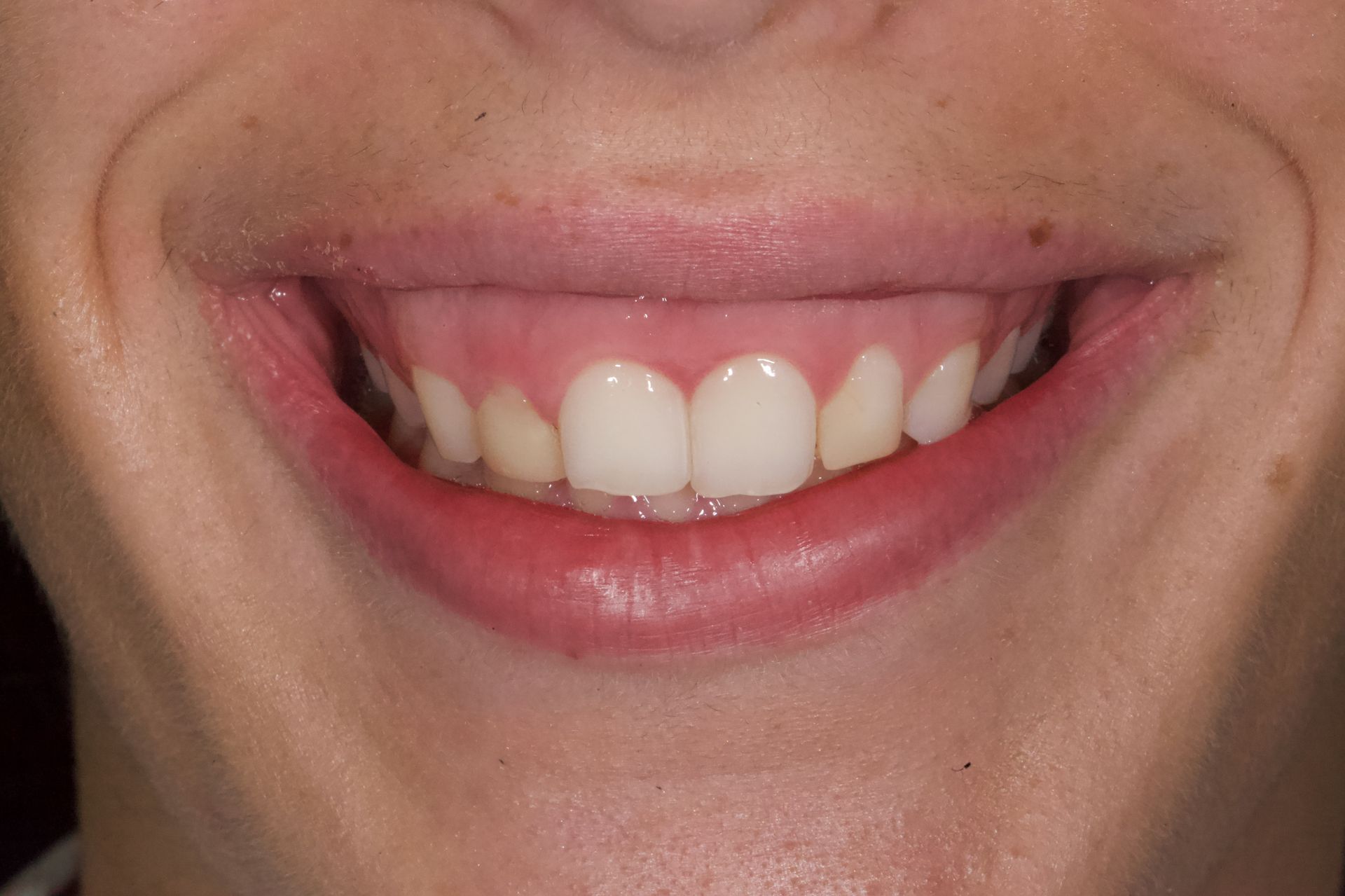 Before Bottom Teeth — Menai, NSW — Top Care Dental
