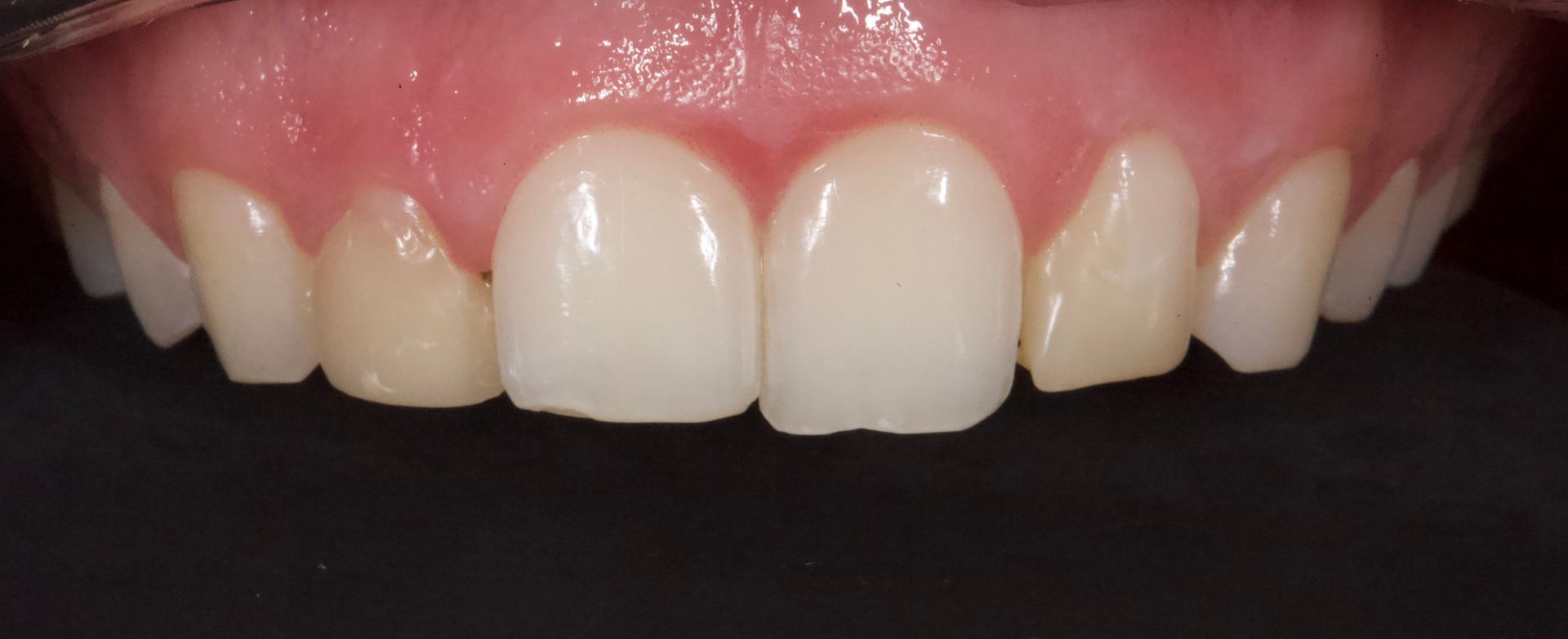 Before Bottom Teeth — Menai, NSW — Top Care Dental