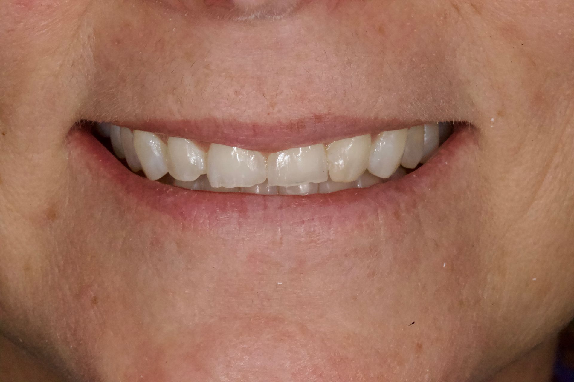Before Bottom Teeth — Menai, NSW — Top Care Dental