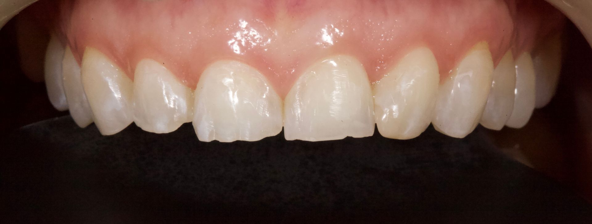 Before Bottom Teeth — Menai, NSW — Top Care Dental