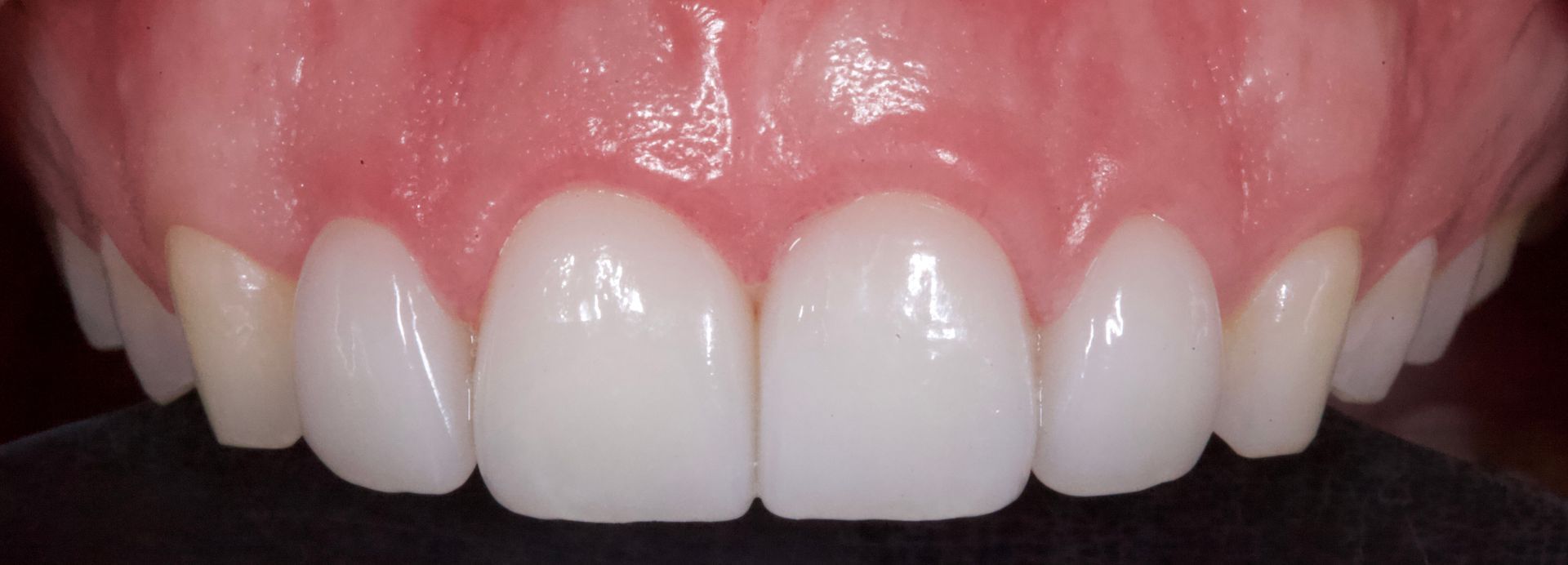 After Bottom Teeth — Menai, NSW — Top Care Dental