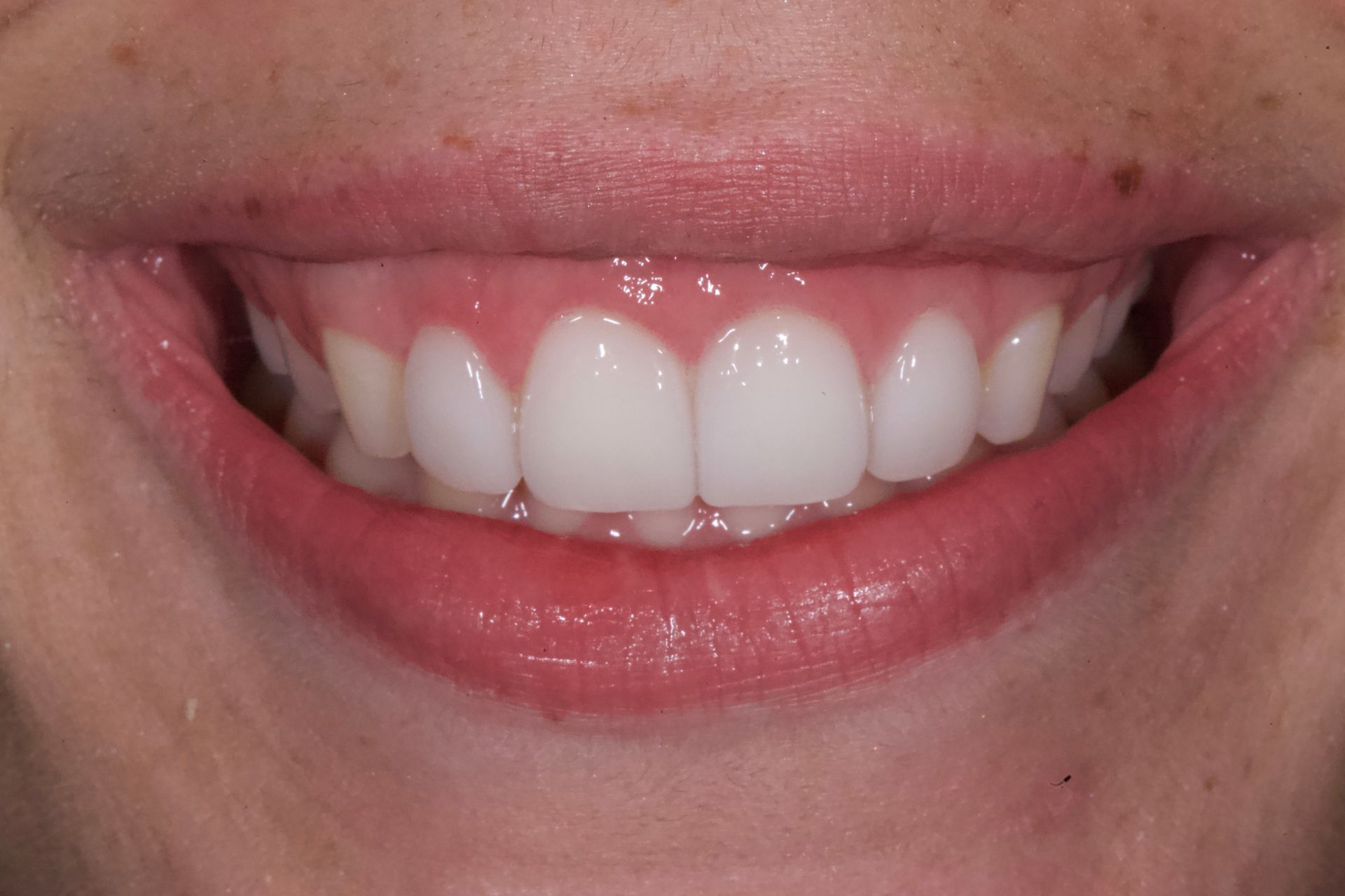 After Bottom Teeth — Menai, NSW — Top Care Dental