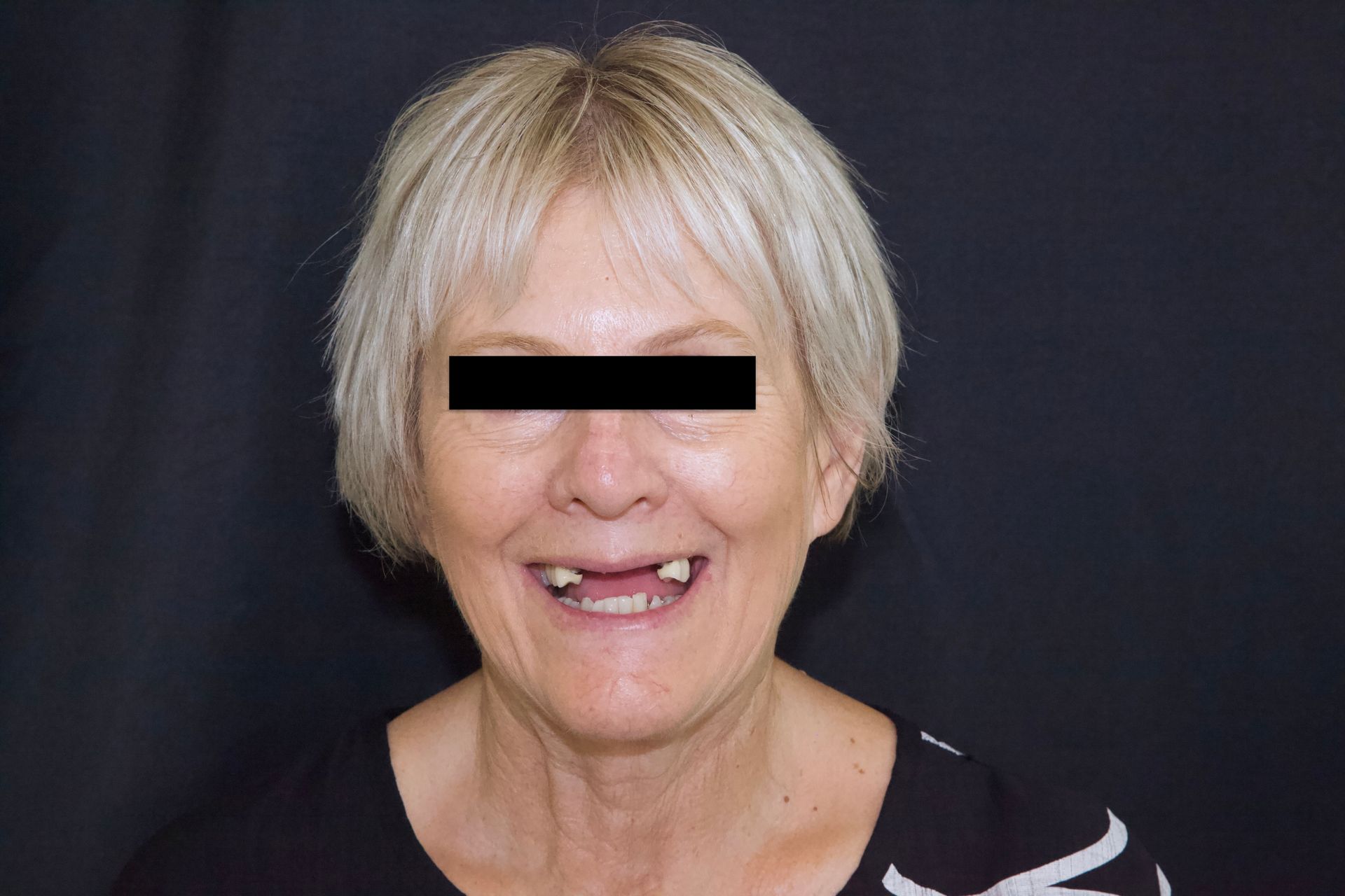 Before Teeth Close-Up — Menai, NSW — Top Care Dental