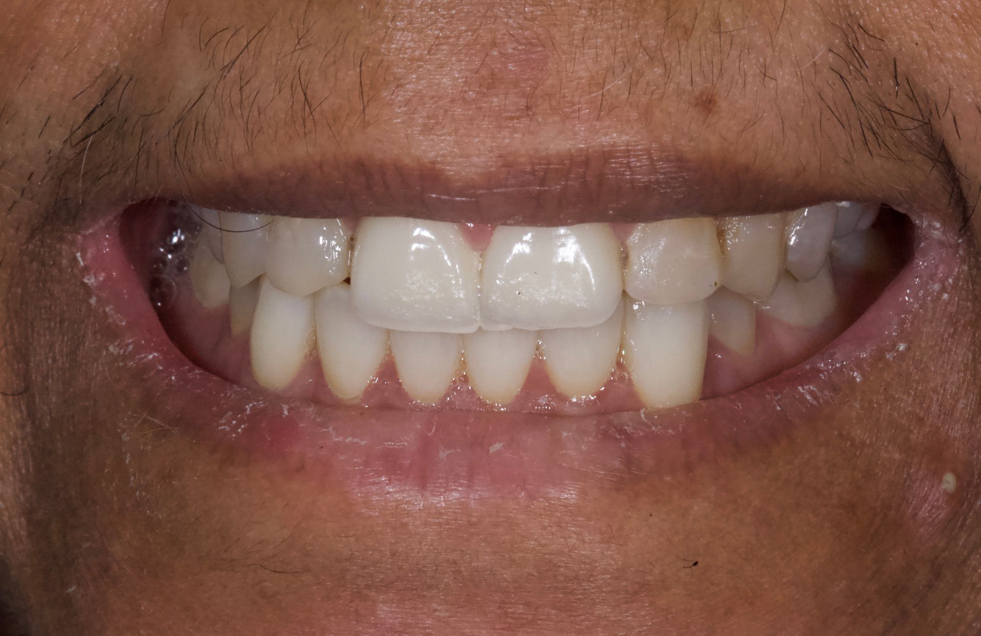 Before Bottom Teeth — Menai, NSW — Top Care Dental